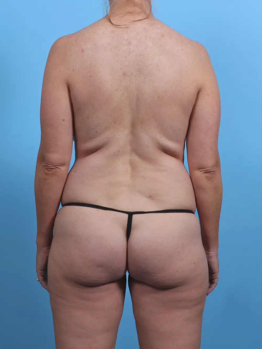 Breast Lift/Reduction with Implants Patient Photo - Case 30212 - before view-3