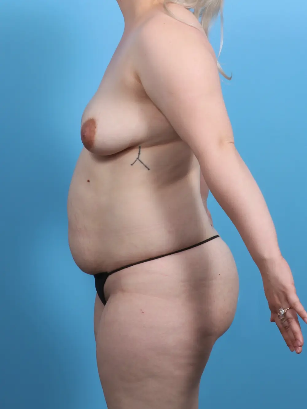 Breast Lift/Reduction with Implants Patient Photo - Case 30112 - before view-2