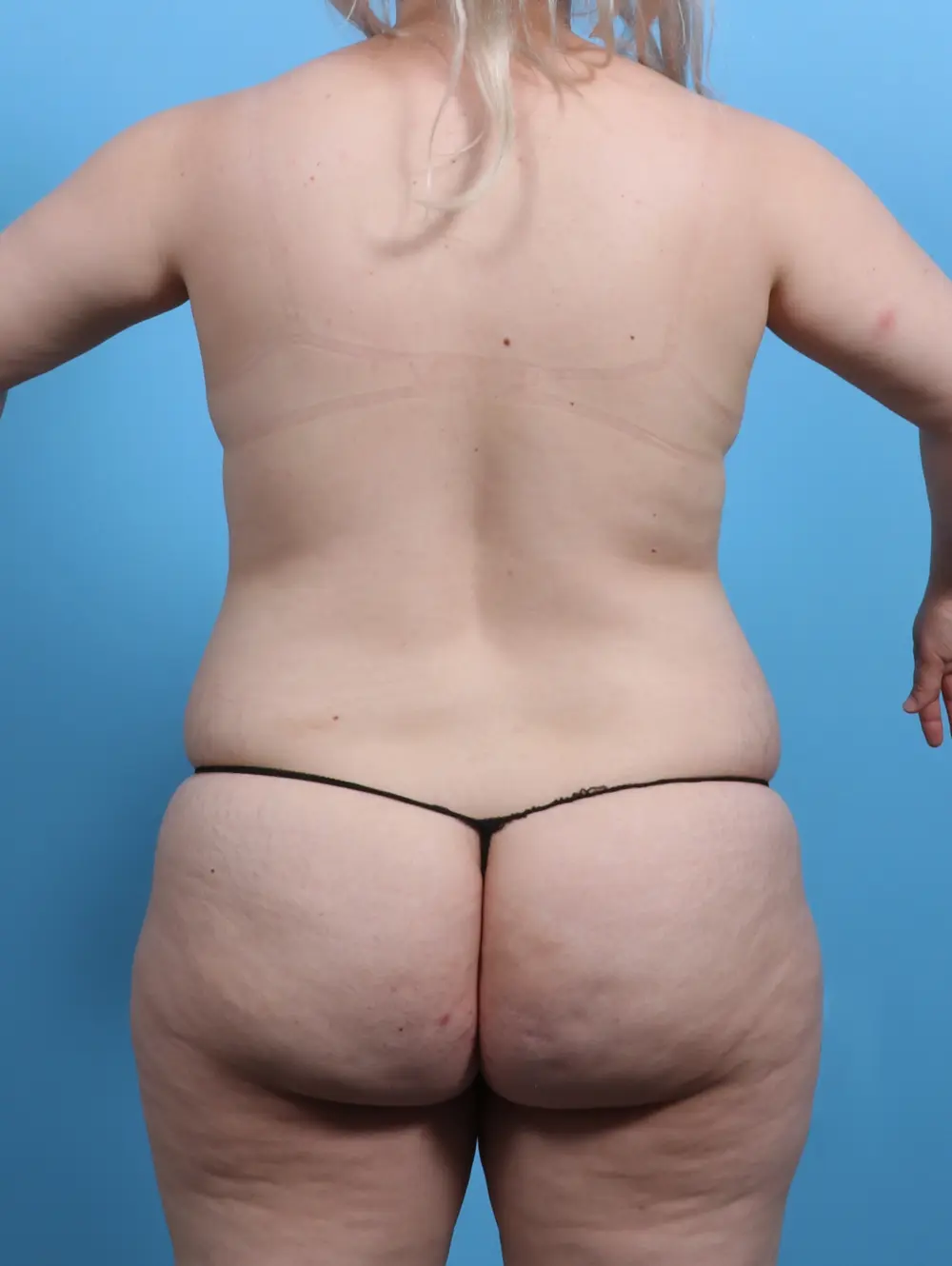 Breast Lift/Reduction with Implants Patient Photo - Case 30112 - before view-3