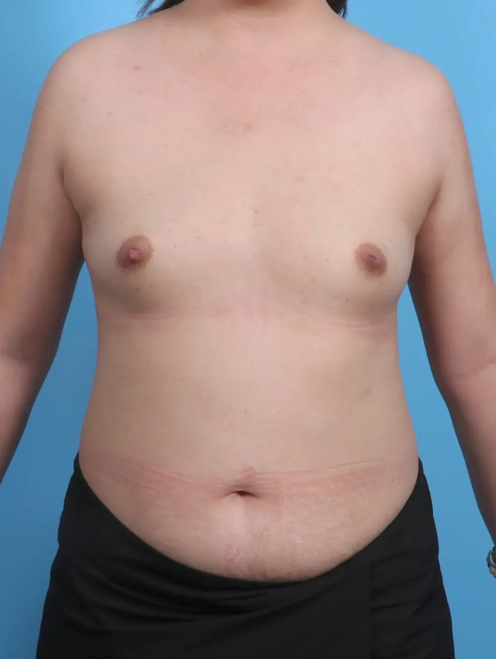 Breast Augmentation Patient Photo - Case 30071 - before view-