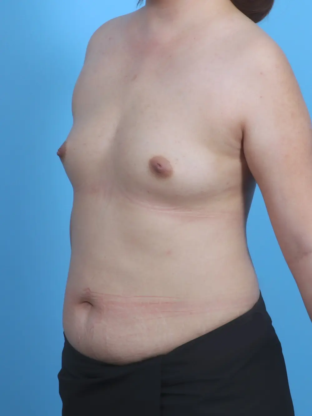 Breast Augmentation Patient Photo - Case 30071 - before view-1