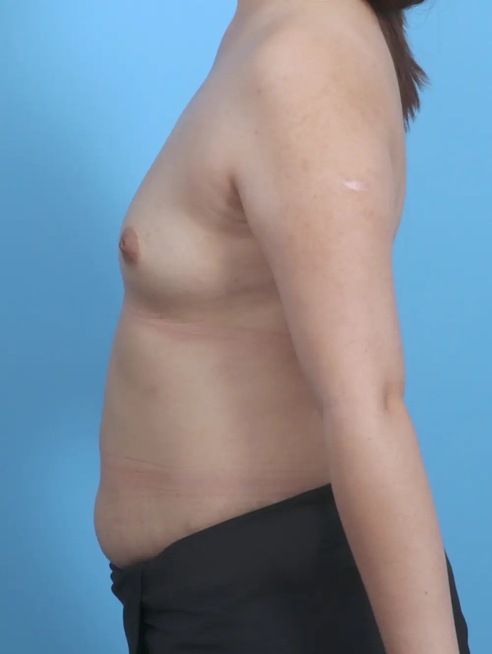 Breast Augmentation Patient Photo - Case 30071 - before view-2