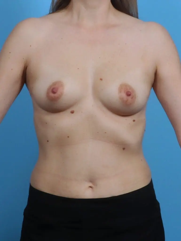 Breast Augmentation - Case 30079 - Before