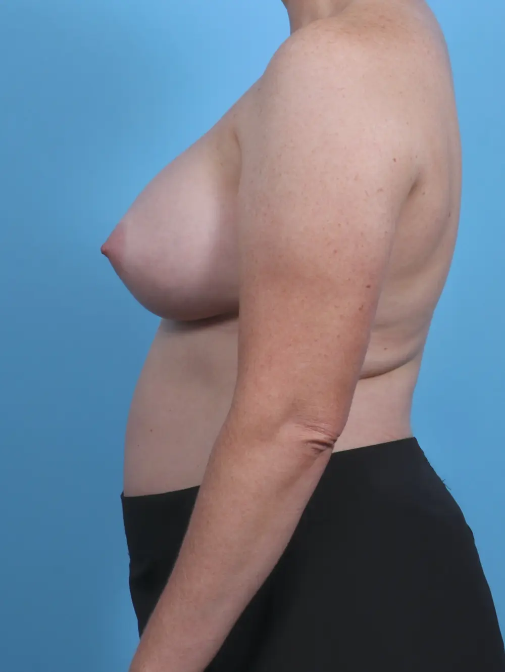 Breast Augmentation Patient Photo - Case 30230 - after view-2