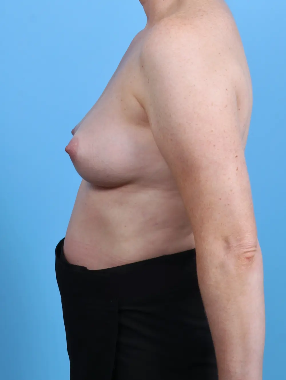 Breast Augmentation Patient Photo - Case 30230 - before view-2