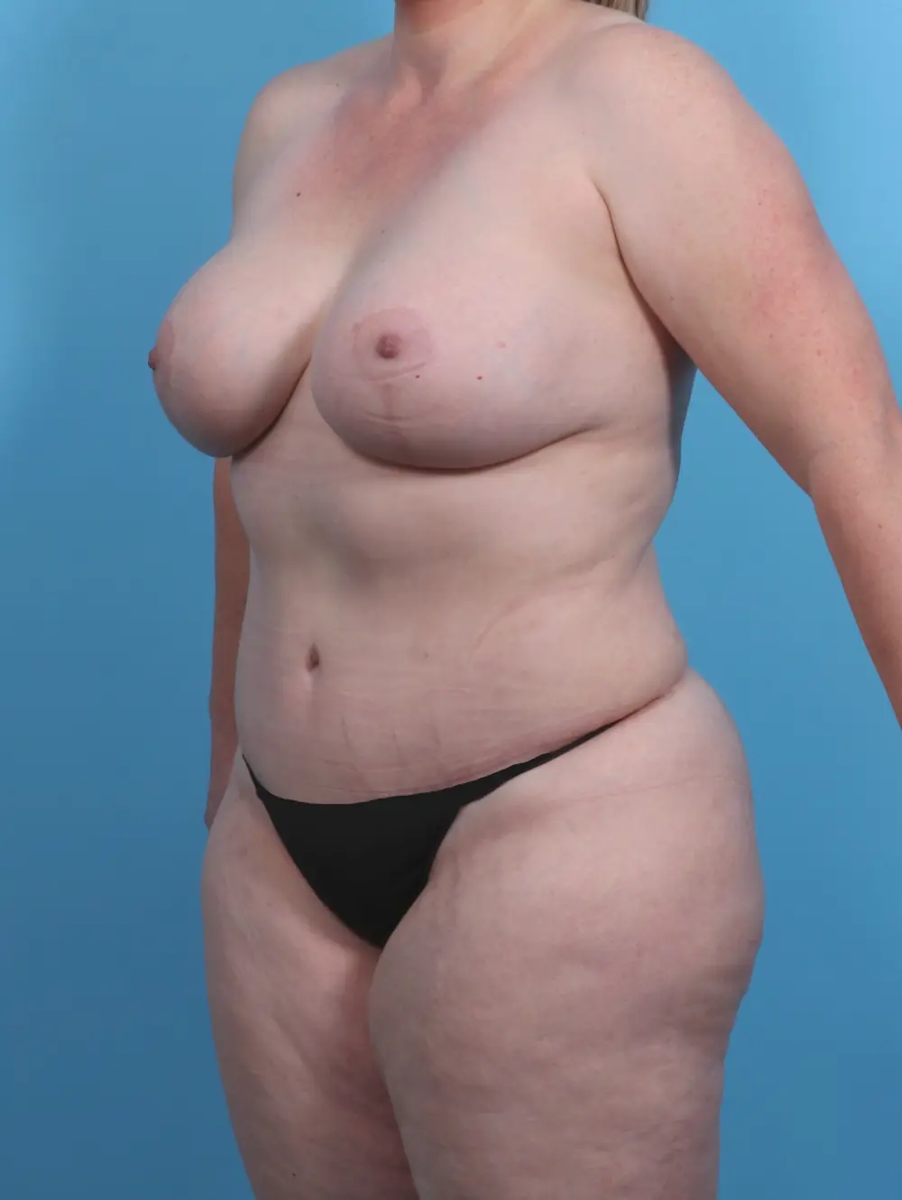 Breast Lift/Reduction with Implants Patient Photo - Case 30381 - after view-1