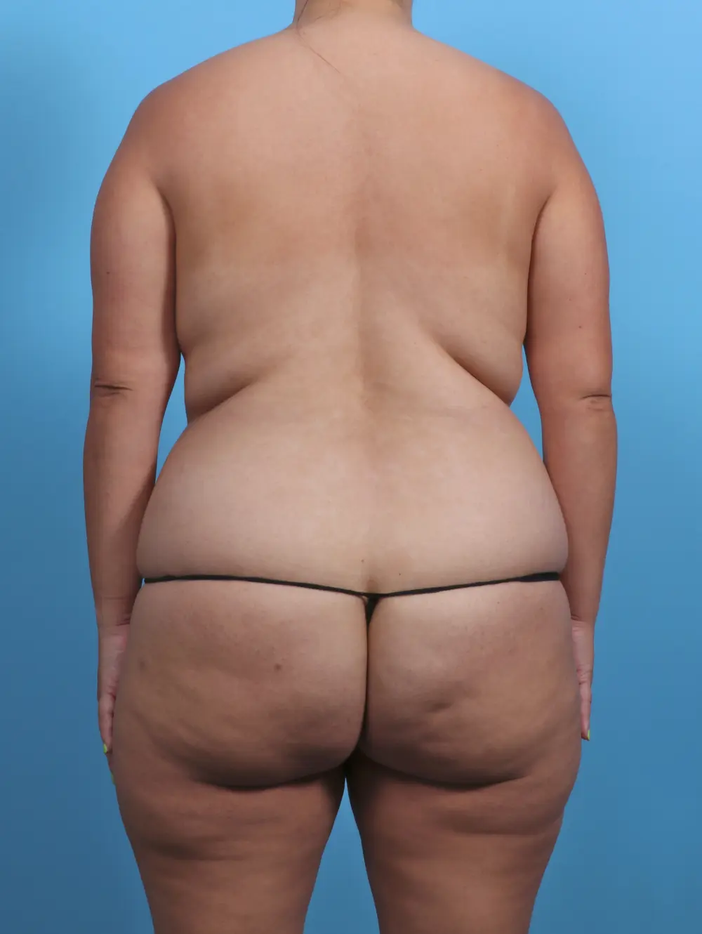 Breast Lift/Reduction with Implants Patient Photo - Case 30320 - before view-3