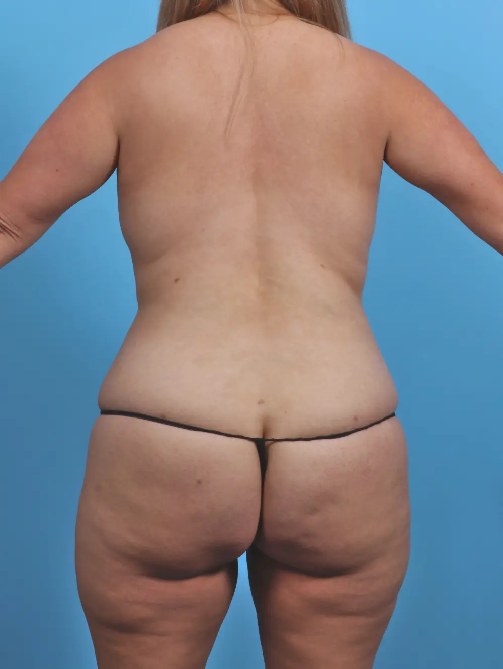 Breast Lift/Reduction with Implants Patient Photo - Case 30320 - after view-3