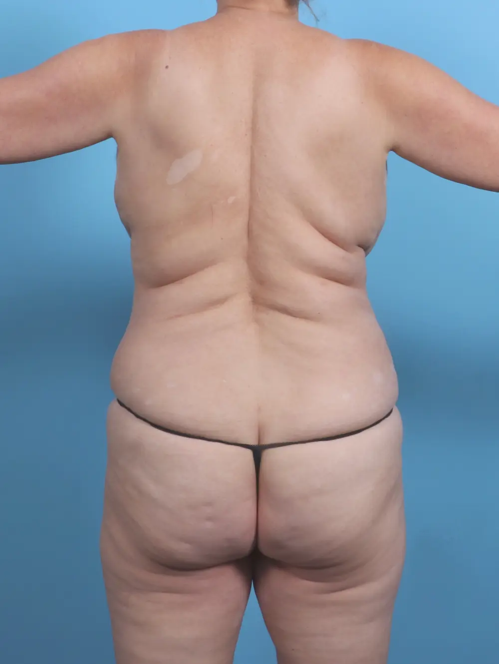 Breast Lift/Reduction w/o Implants Patient Photo - Case 30398 - after view-3