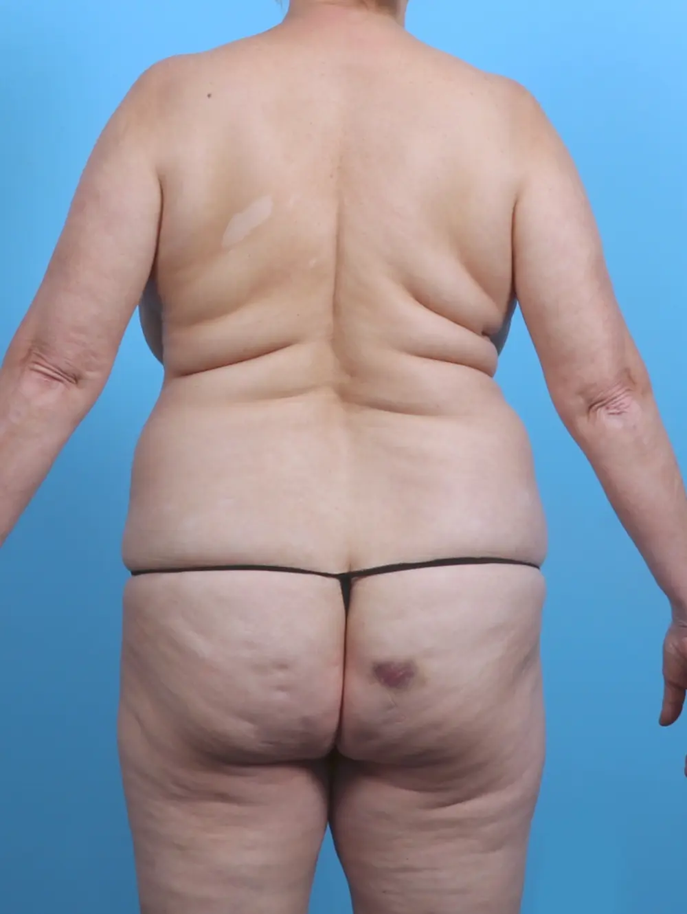 Breast Lift/Reduction w/o Implants Patient Photo - Case 30398 - before view-3