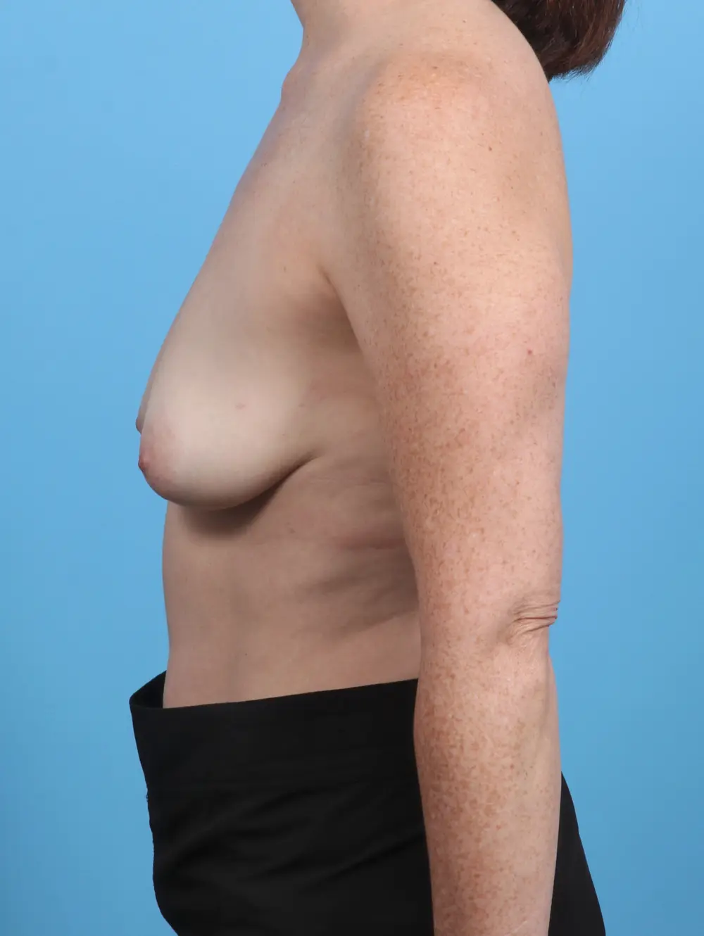 Breast Lift/Reduction w/o Implants Patient Photo - Case 30123 - before view-2