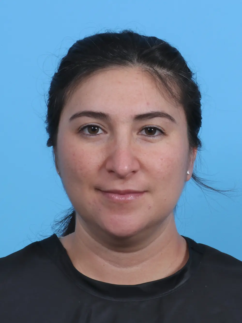 Rhinoplasty Patient Photo - Case 30247 - after view-2