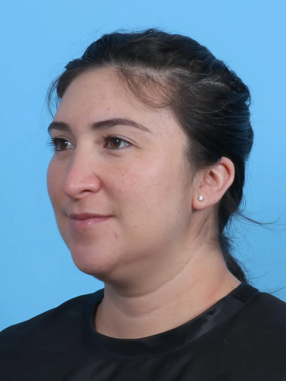 Rhinoplasty Patient Photo - Case 30247 - after view-1