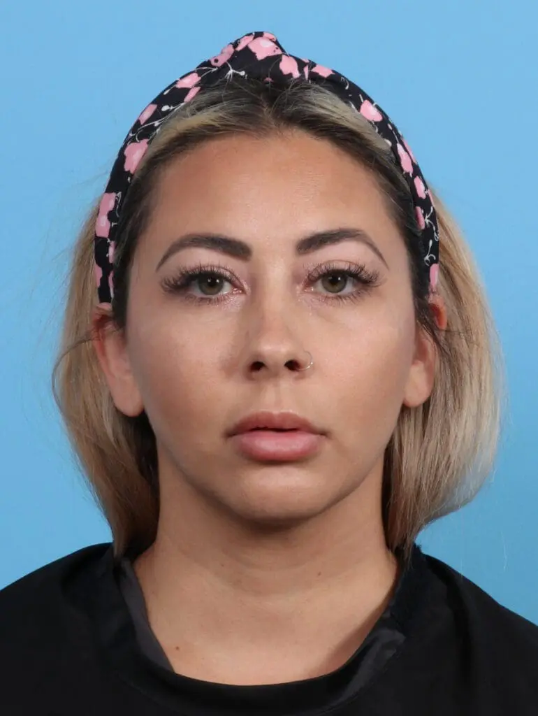 Liposuction - Case 30336 - Before