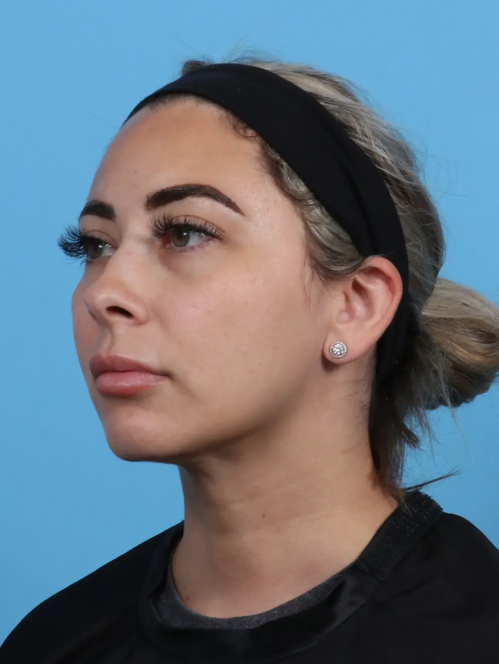 Liposuction Patient Photo - Case 30336 - after view-1