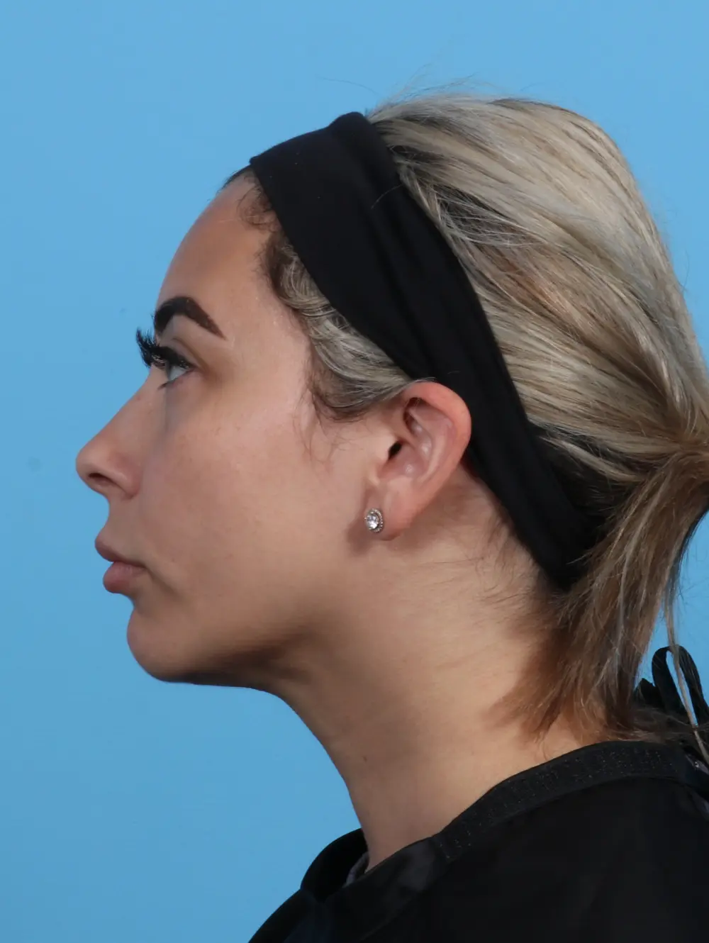 Liposuction Patient Photo - Case 30336 - after view-2