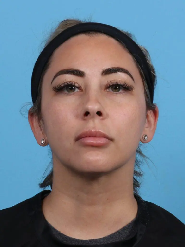 Liposuction - Case 30336 - After