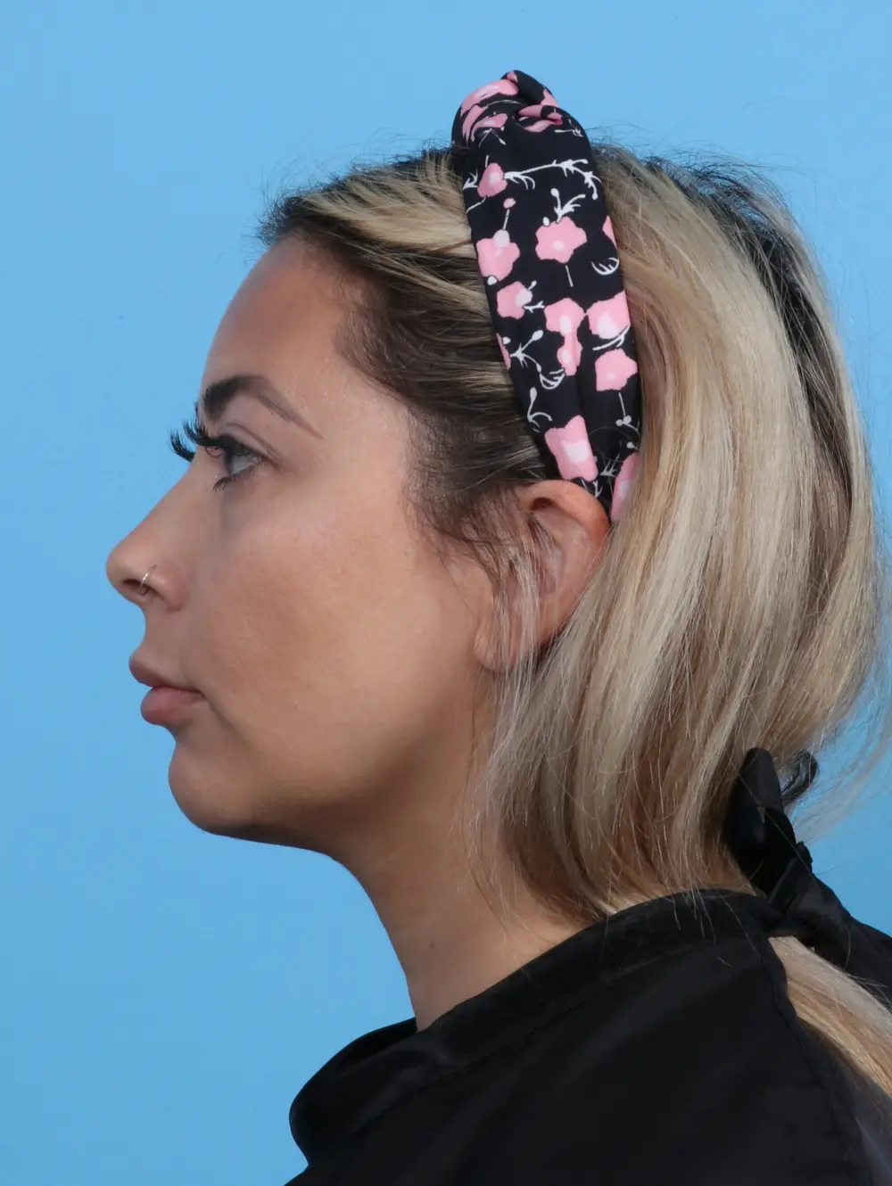 Liposuction Patient Photo - Case 30336 - before view-2