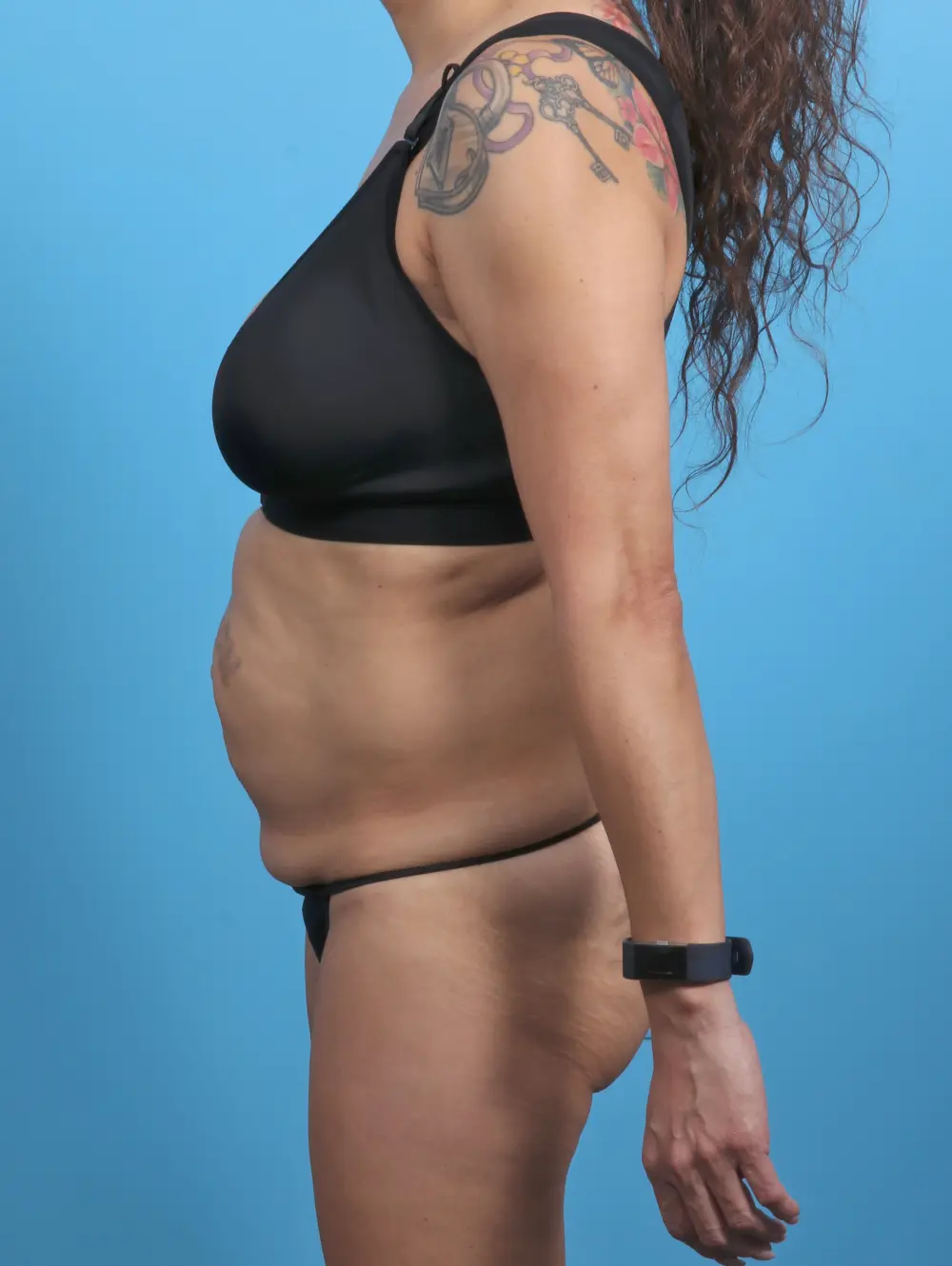 Tummy Tuck Patient Photo - Case 30438 - before view-2