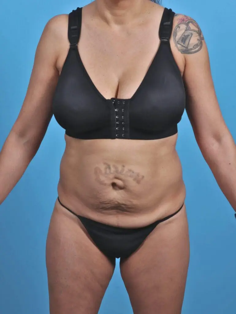 Tummy Tuck - Case 30438 - Before