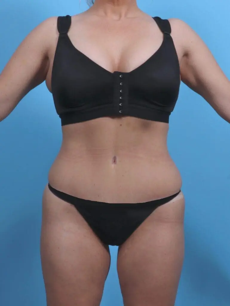 Tummy Tuck - Case 30338 - After