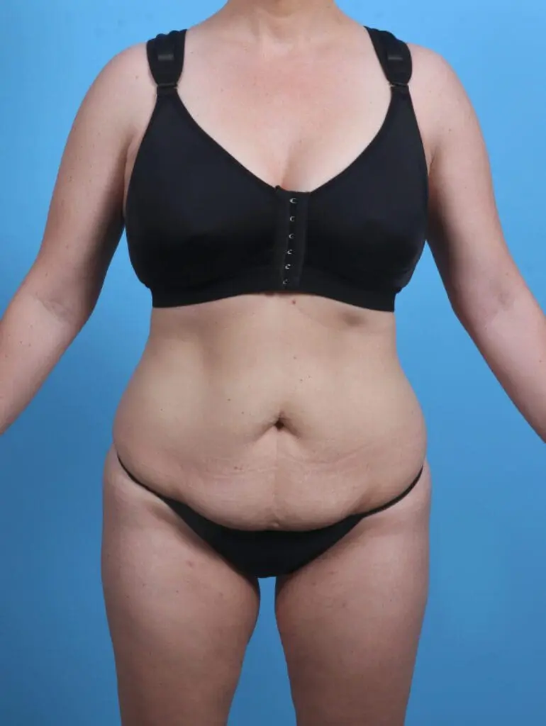 Tummy Tuck - Case 30338 - Before