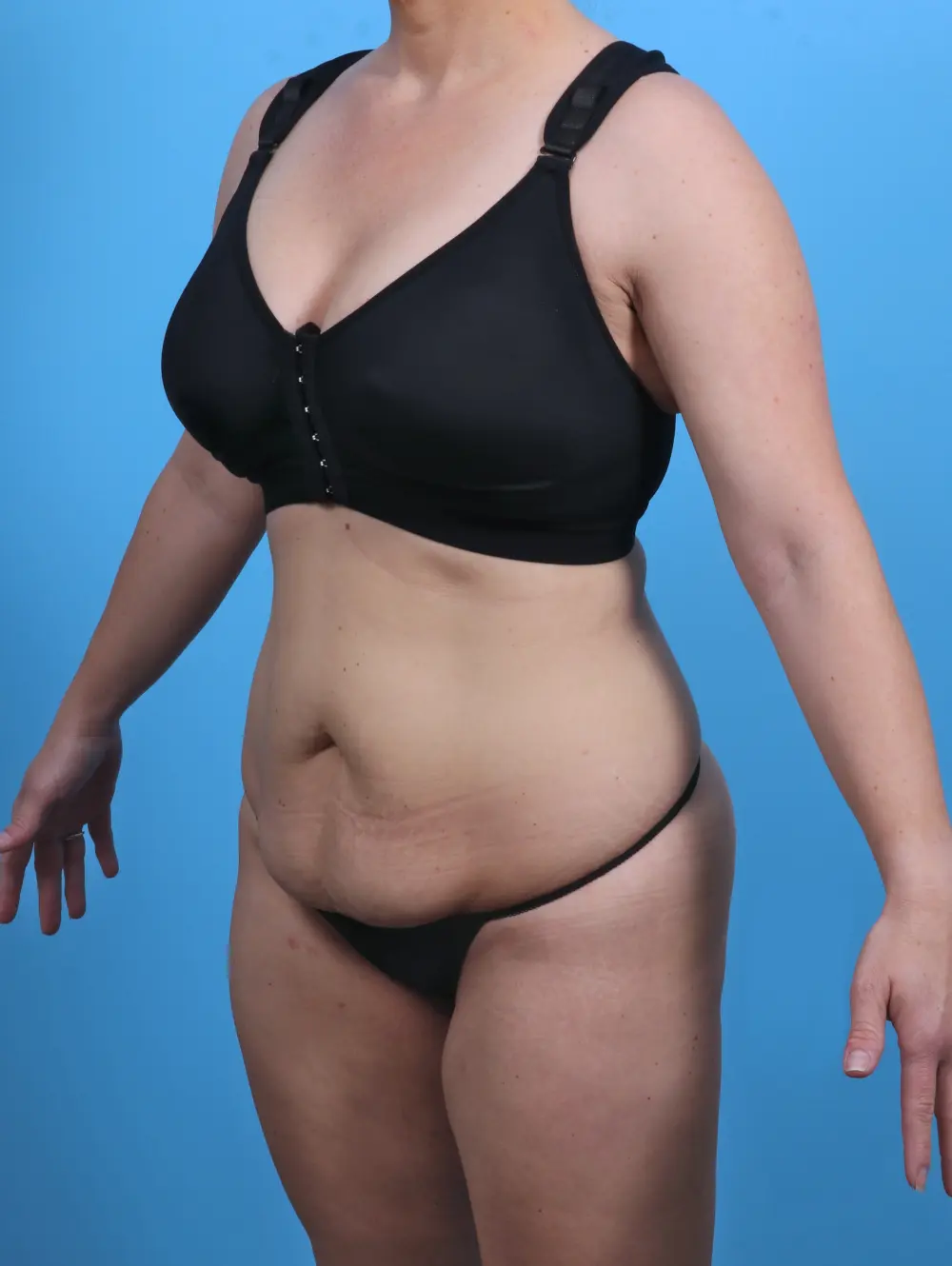 Tummy Tuck Patient Photo - Case 30338 - before view-1