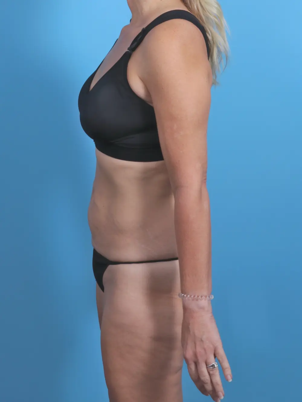 Tummy Tuck Patient Photo - Case 30271 - before view-2