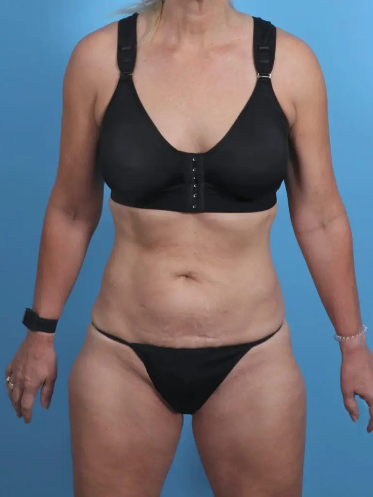 Tummy Tuck - Case 30271 - Before