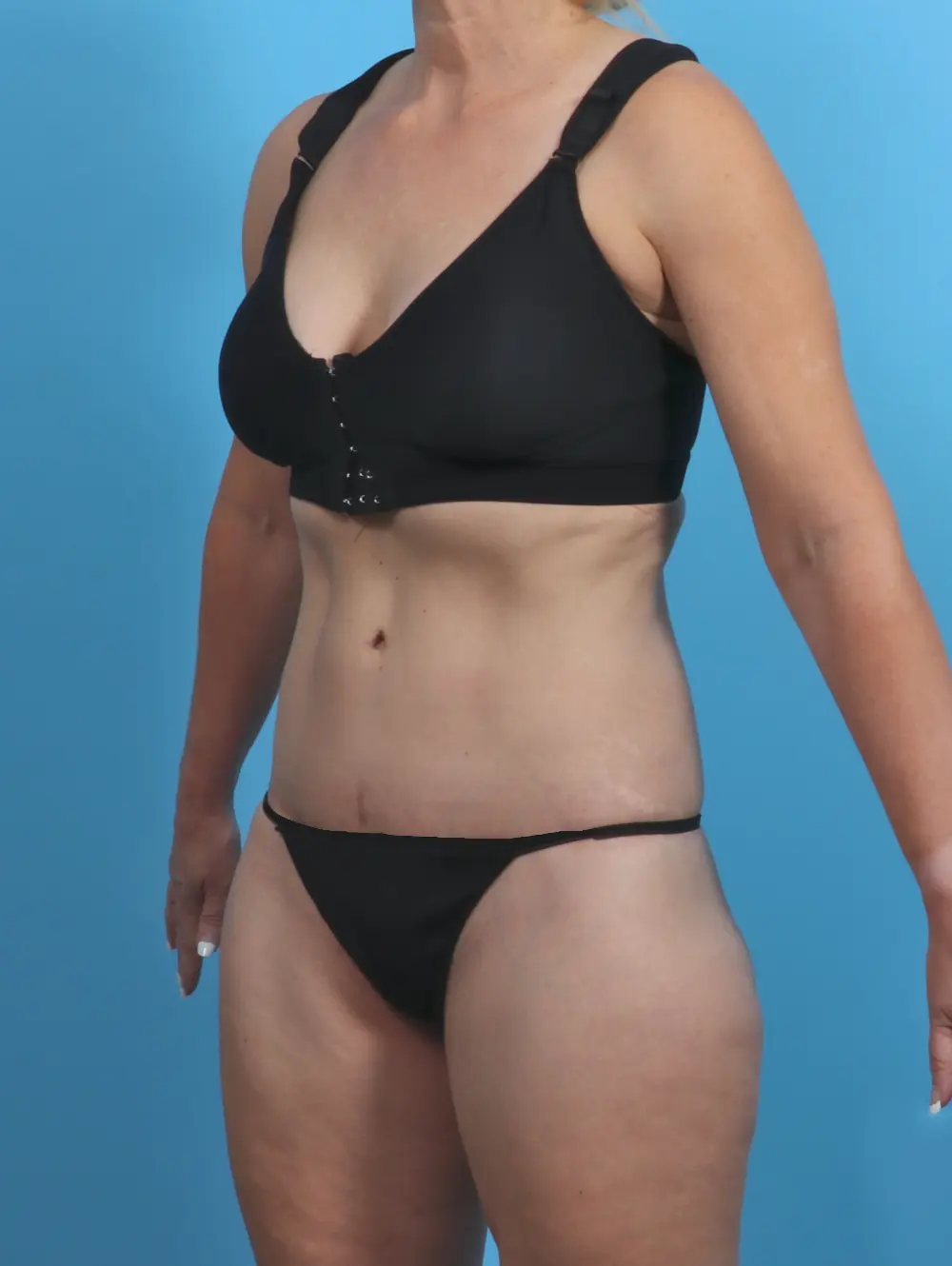 Tummy Tuck Patient Photo - Case 30271 - after view-1