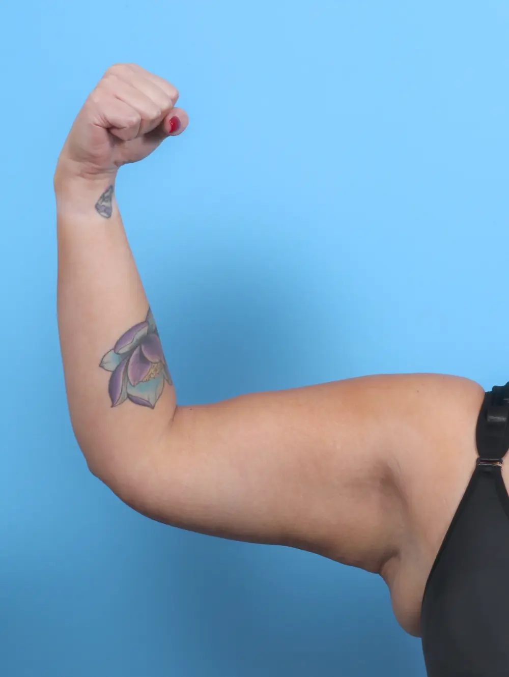 Arm Lift Patient Photo - Case 44831 - after view-1