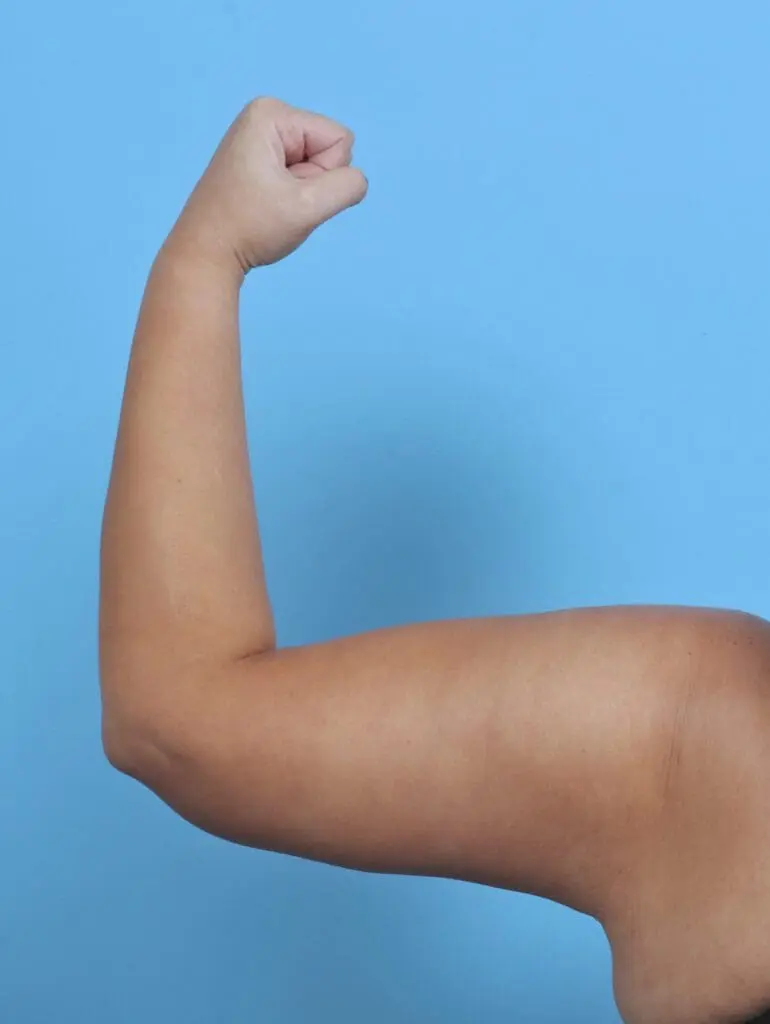 Arm Lift - Case 44831 - After