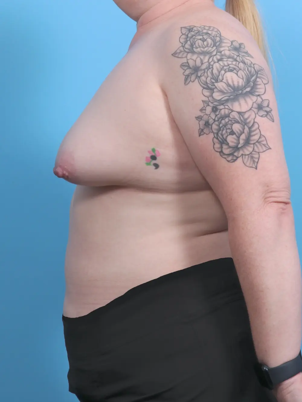 Breast Lift/Reduction with Implants Patient Photo - Case 44836 - before view-2