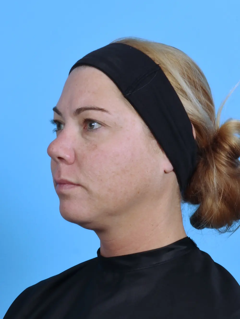 Eyelid Surgery Patient Photo - Case 44867 - before view-1