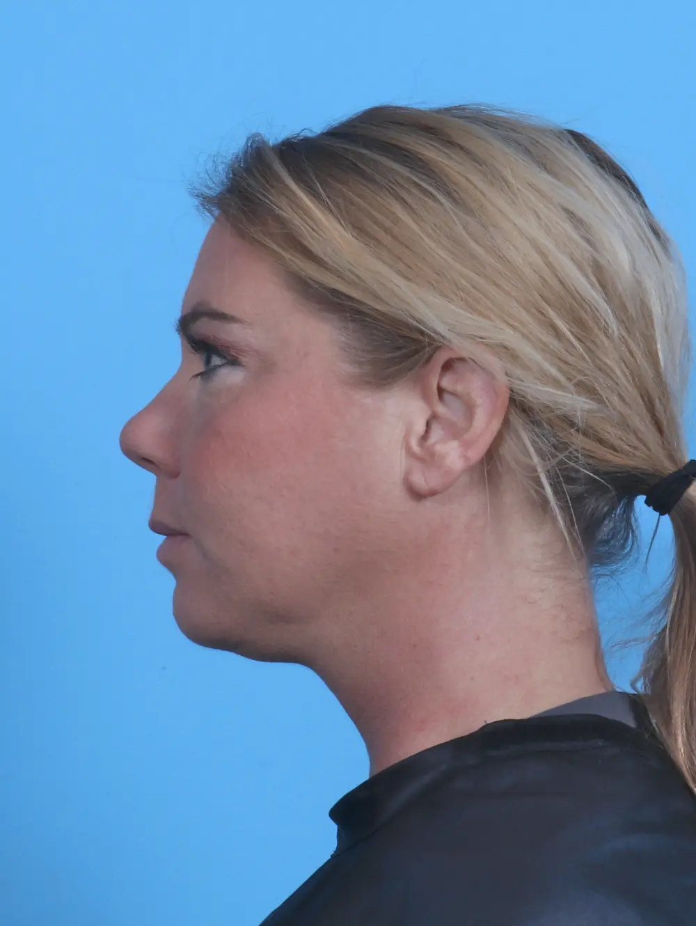 Eyelid Surgery Patient Photo - Case 44867 - after view-2