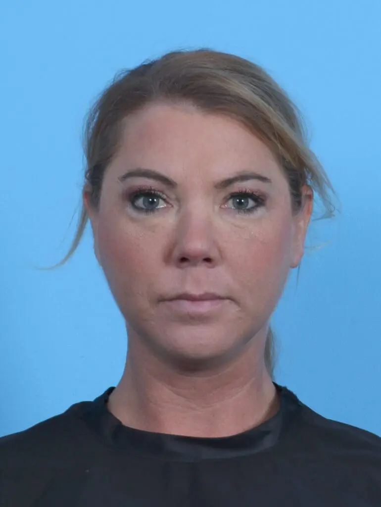 Eyelid Surgery - Case 44867 - After