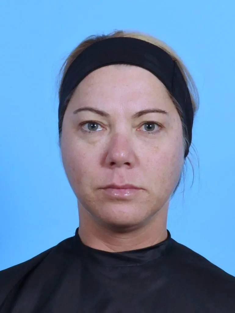 Eyelid Surgery - Case 44867 - Before