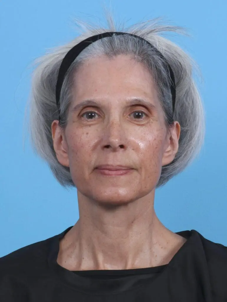 Facelift / Neck Lift - Case 44895 - After