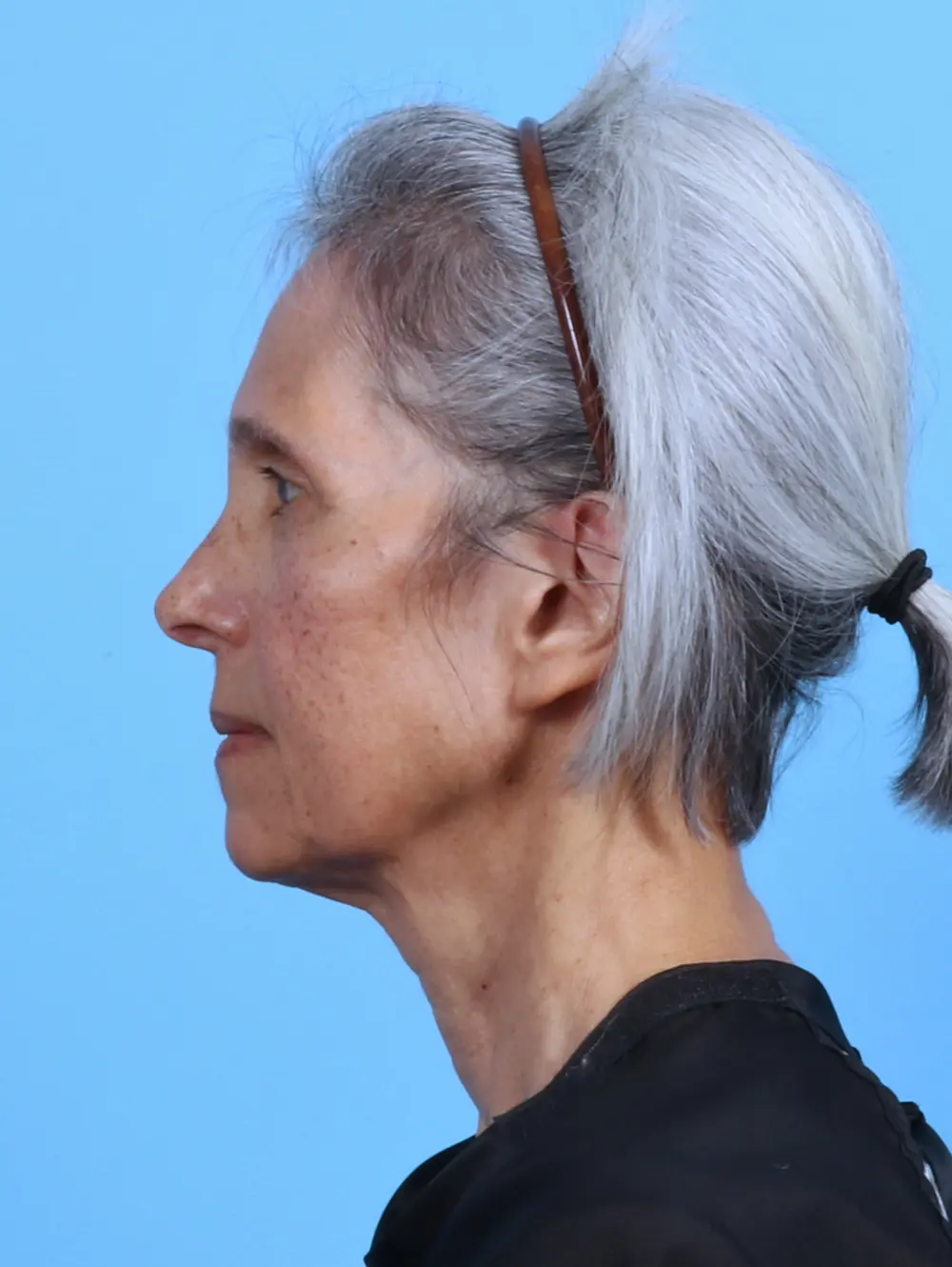 Facelift / Neck Lift Patient Photo - Case 44895 - before view-2