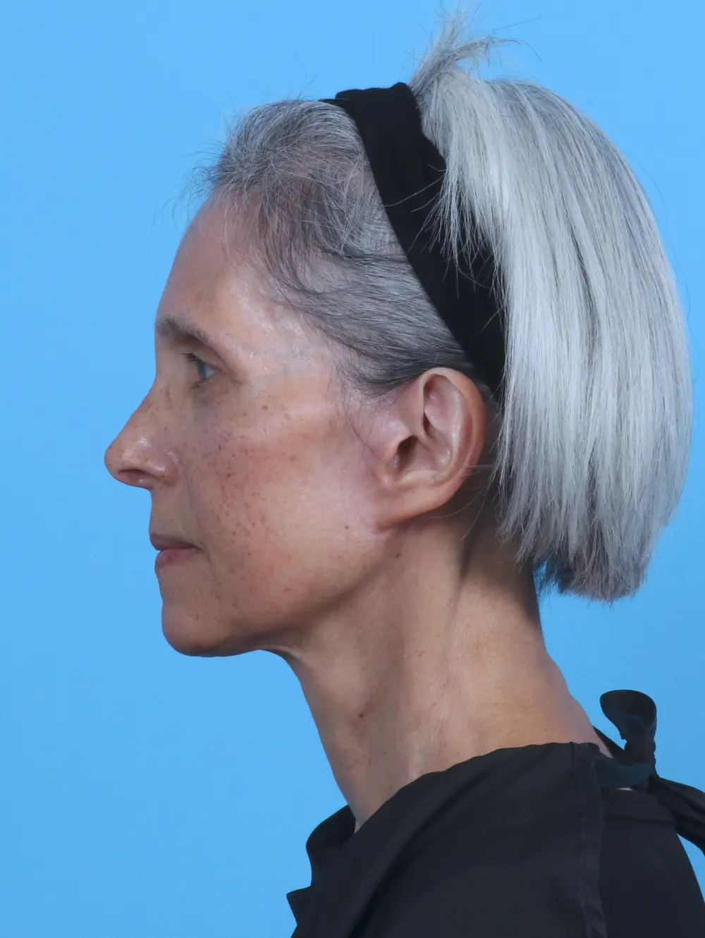 Facelift / Neck Lift Patient Photo - Case 44895 - after view-2
