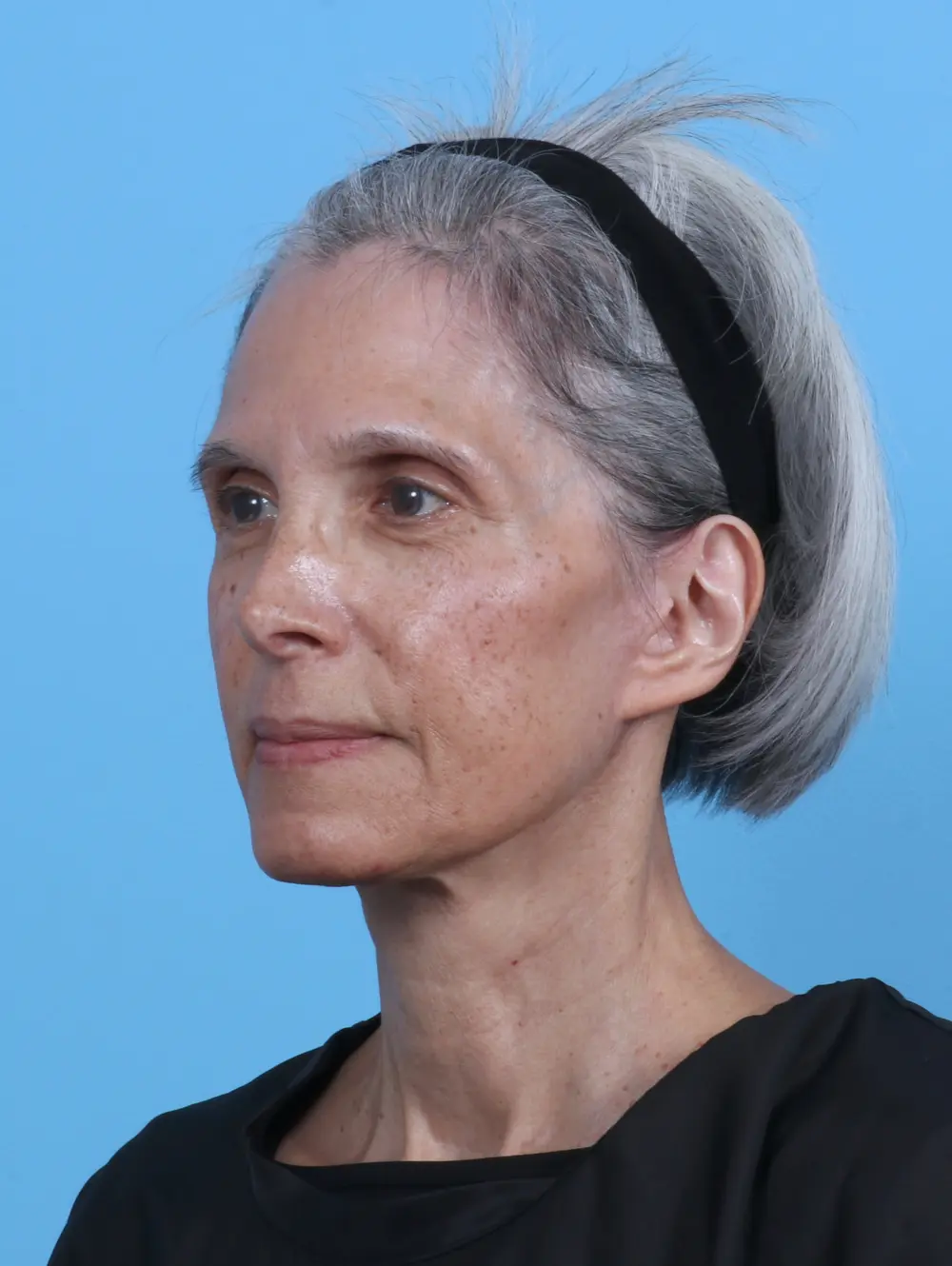 Facelift / Neck Lift Patient Photo - Case 44895 - after view-1
