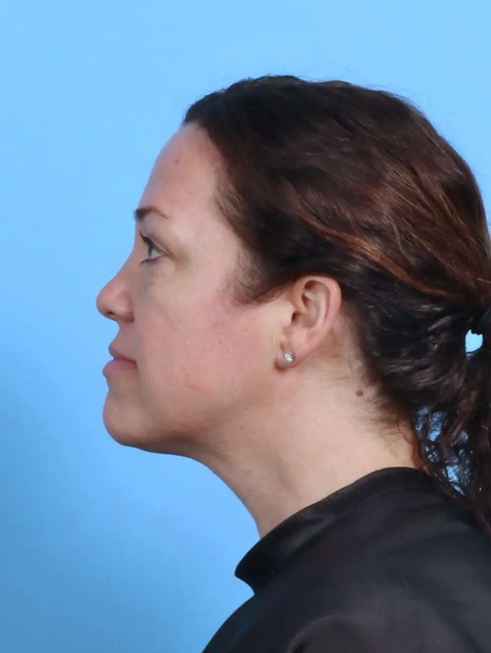 Eyelid Surgery Patient Photo - Case 44930 - before view-2