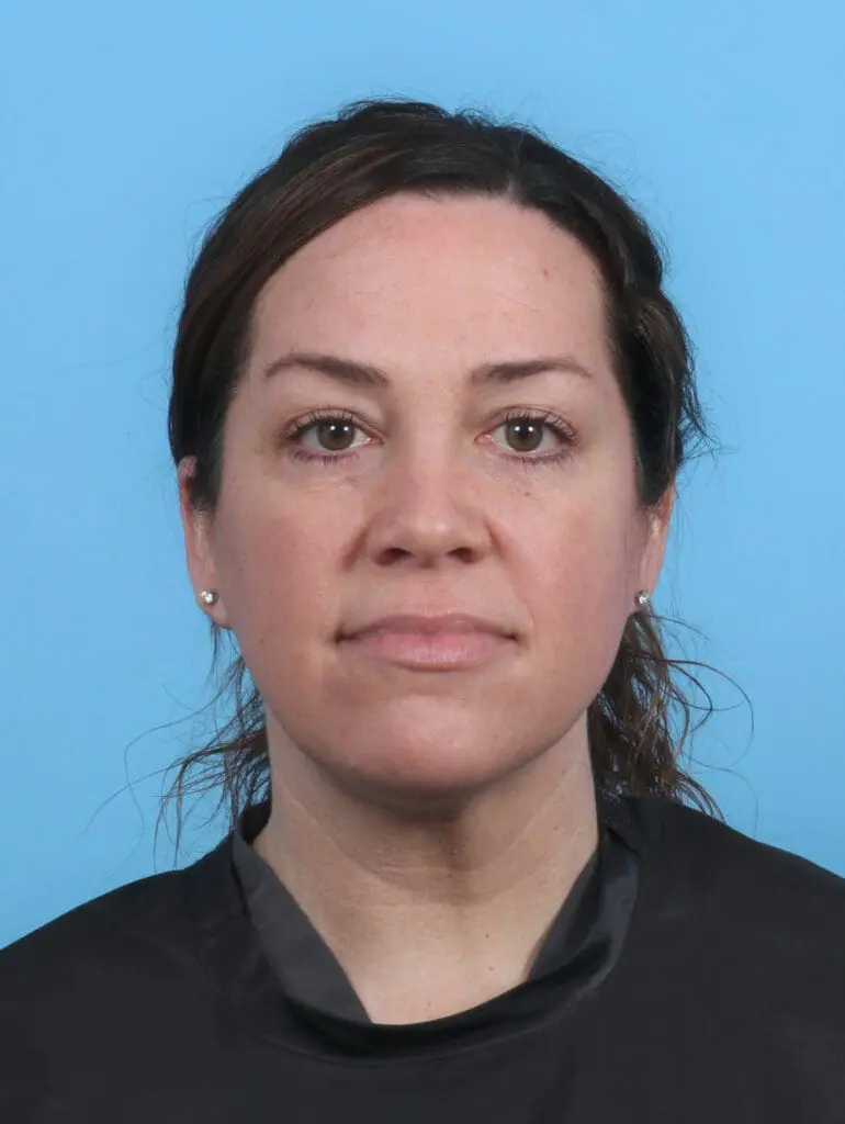 Eyelid Surgery - Case 44930 - After