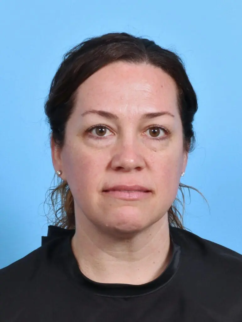 Eyelid Surgery - Case 44930 - Before