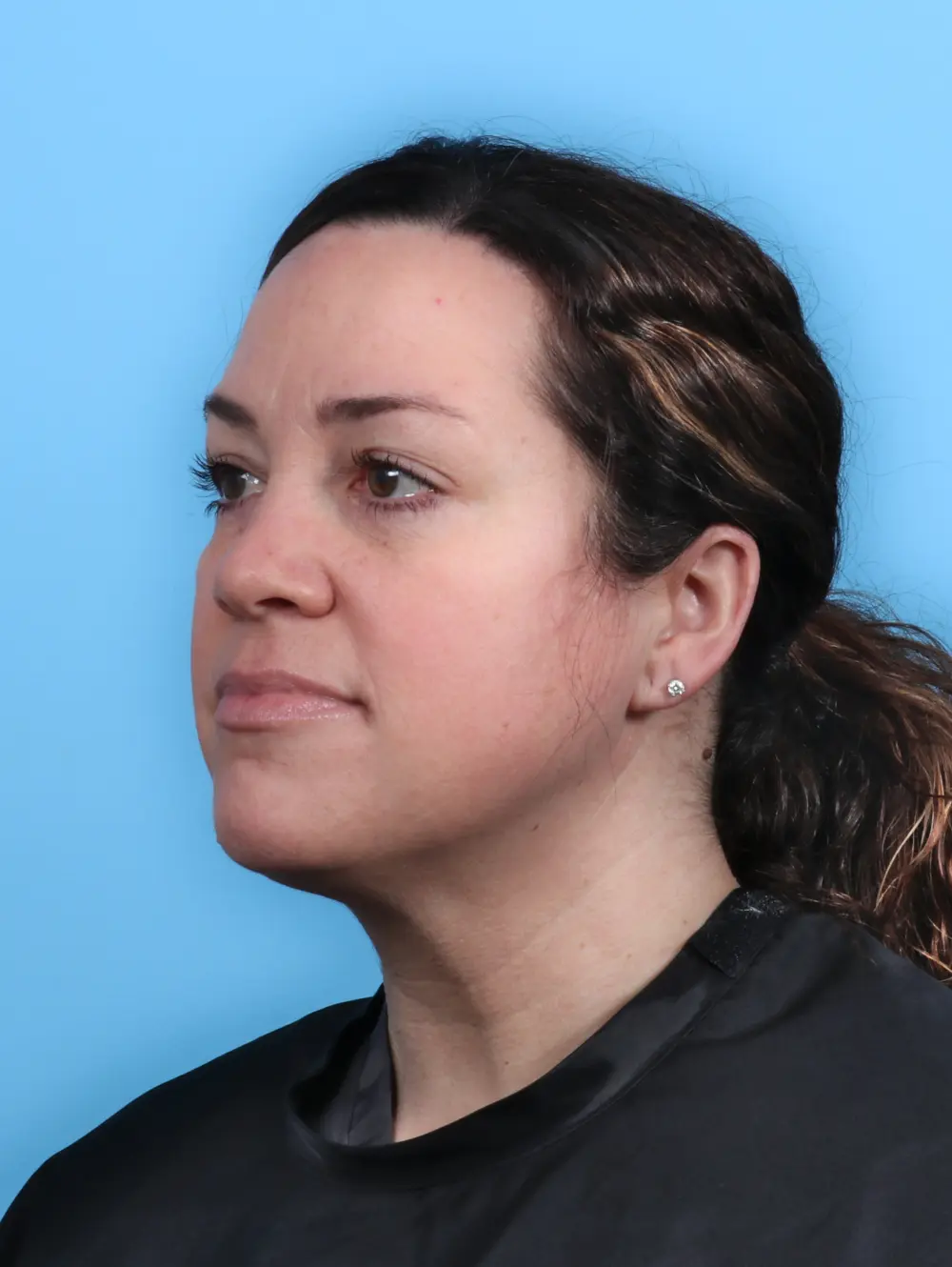 Eyelid Surgery Patient Photo - Case 44930 - after view-1