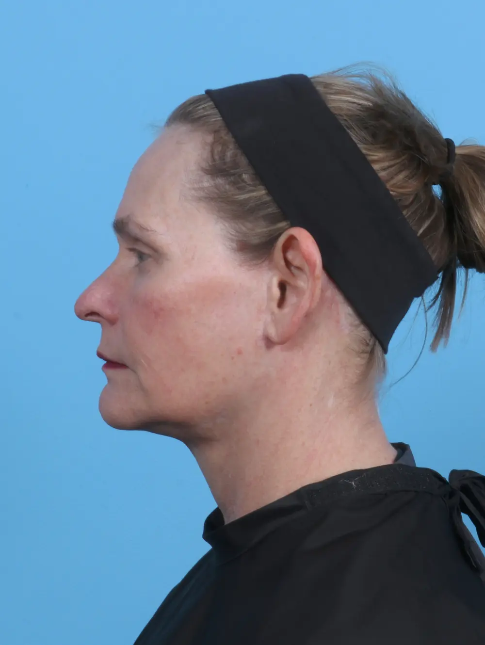 Facelift / Neck Lift Patient Photo - Case 44953 - after view-2