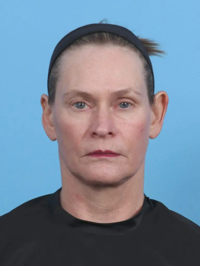 Facelift / Neck Lift - Case 44953 - After