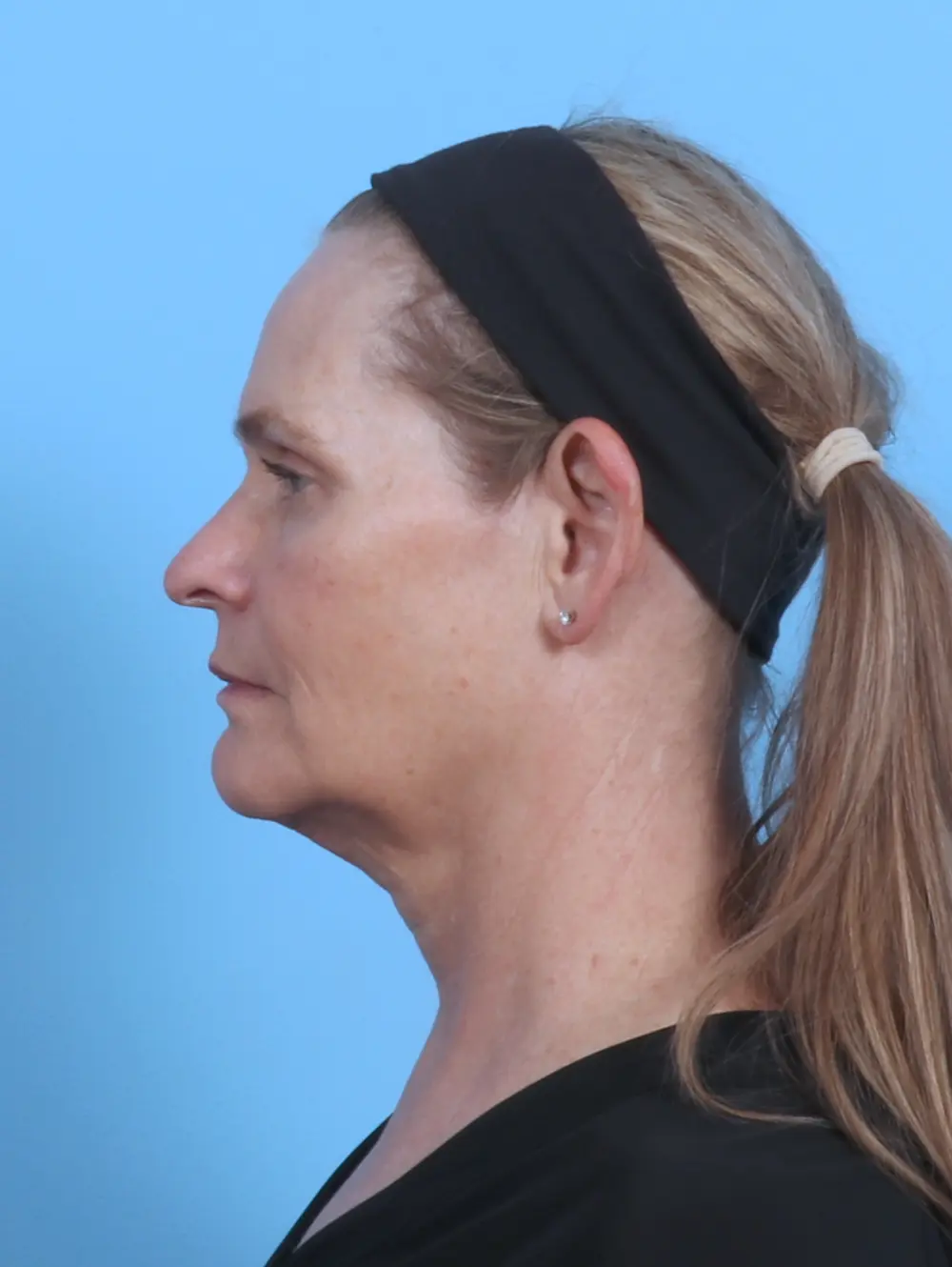 Facelift / Neck Lift Patient Photo - Case 44953 - before view-2