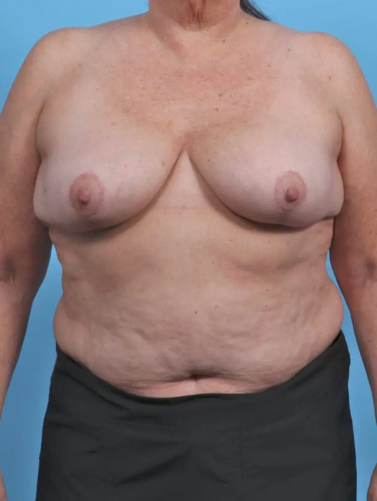 Breast Implant Removal - Case 44967 - After
