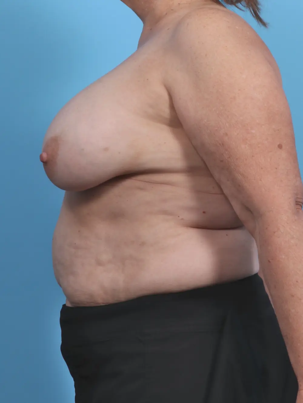 Breast Implant Removal Patient Photo - Case 44967 - before view-2